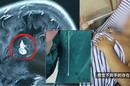 بطول 13سم ..دودة شريطية تسكن دماغ شاب وتتسبب في معاناته ! (فيديو)