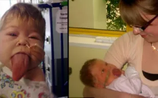 لسان طفلة بريطانية لم يتوقف عن النمو منذ ولادتها لسان طفلة بريطانية لم يتوقف عن النمو منذ ولادتها