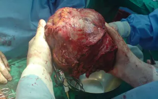 استئصال أكبر ورم في العالم من فلسطيني 