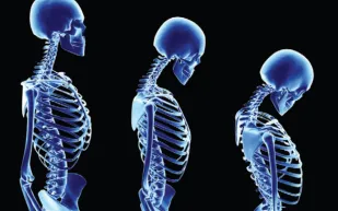 كيف تحمي نفسك من هشاشة العظام؟