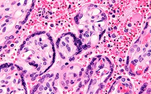 دراسة: فيروس الملاريا يعالج 9 أنواع من السرطان