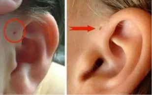 ماذا تعني هذه العلامة أعلى الأذن