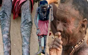 شاهد.. هندي يبدل جلده كالأفعى كل 10 أيام!