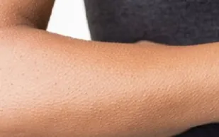 بشرى.. القشعريرة مؤشر للسعادة والصحة الجسدية والعقلية