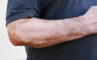 ما سبب ظهور مرض البهاق؟ وكيف يتم علاجه؟