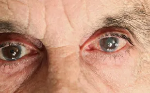 تقارير طبية تكشف أرقاما صادمة عن انتشار أمراض العيون بالسعودية