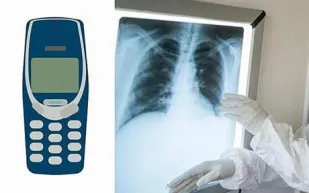 طبيب يكتشف هاتفًا محمولاً في معدة سجين