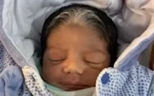 ولادة نادرة لطفل بدون جلد والأطباء يكشفون السبب (فيديو)