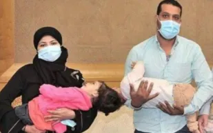 السعودية تحقق حلم طفلتين مصريتين ملتصقتي الرأس