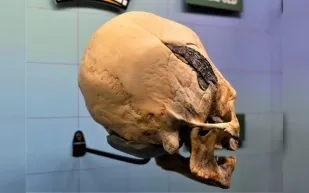 جمجمة بشرية مخروطية تضم معادن غريبة تثير حيرة العلماء (فيديو)