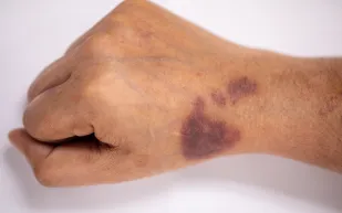 ظهر في مسلسل بطلوع الروح.. ما هو مرض الهيموفيليا الذي يصيب الرجال؟