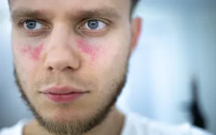 مرض الذئبة الحمراء.. أسبابه وأعراضه وكيفية العلاج    