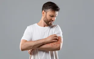 كل ما تريد معرفته عن مرض الصدفية: أعراضه وأسبابه وطرق العلاج 