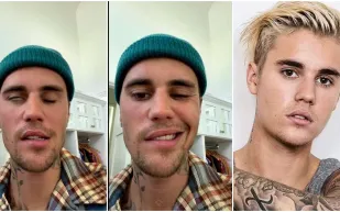 ما هي متلازمة «رامزي هانت» التي أصابت جاستن بيبر بشلل في الوجه؟ (فيديو)