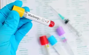 «ماربورغ» الفيروس الفتاك يهدد البشر من جديد.. فما أعراضه؟