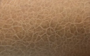 داء السمك.. هل هو مُعد؟ وما هي أفضل النصائح للتعامل معه؟