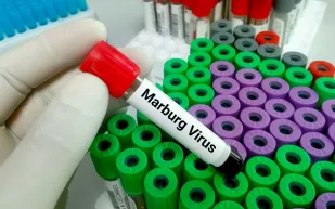 إصابات بفيروس «ماربورغ» في غينيا الاستوائية وتنزانيا.. وهذه أبرز أعراضه