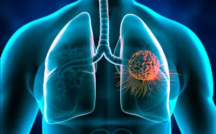 تحذير لغير المدخنين.. الهواء الملوث يسبب سرطان الرئة