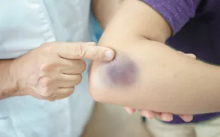 هل تزعجك ألوان الكدمات في جسدك؟.. 5 خطوات للتخلص منها نهائيًا