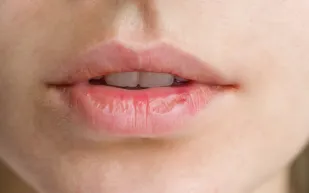 احذر.. جفاف الفم قد يكون علامة على الإصابة بأمراض خطيرة