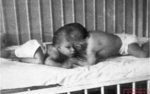 لوري وجورج شابيل.. وفاة التوأم الملتصق الأكبر في العالم