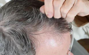 هل انتهى عصر الصلع؟ اكتشاف ثوري يعيد الأمل لنمو الشعر