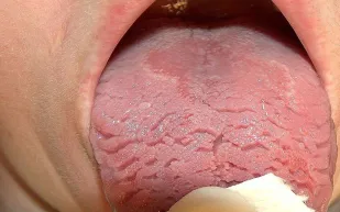 ماذا يكشف اللسان الصدفي عن صحتك؟.. طبيبة أسنان تجيب 