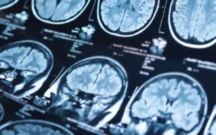 اضطراب ما بعد الصدمة أكثر تعقيدًا مما كنا نعتقد.. دراسة جديدة توضح العوامل المؤثرة