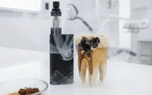 أضرار التدخين الإلكتروني.. طبيبة تكشف خطرًا جديدًا على الأسنان