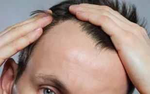  دراسة تحذر: "فيناسترايد" لعلاج الصلع قد يكون مسببًا لمشاكل نفسية خطيرة