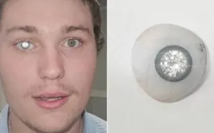 مرصعة بألماسة حقيقية.. القصة الكاملة لأغلى عين اصطناعية في العالم (فيديو)