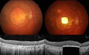 ابتكار طبي: زراعة عين إلكترونية يعيد الرؤية لمرضى فقدان البصر