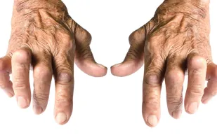 هشاشة العظام تحصد لاعبي كرة القدم بعد الاعتزال.. ما السبب؟