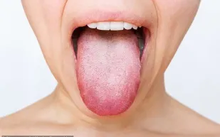 أطباء يوضحون دلالات لون اللسان على صحة الجسم