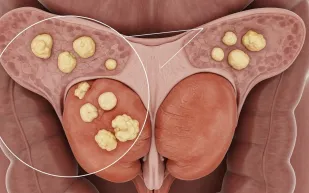 العلاج المكثف لسرطان البروستاتا قد يهدد حياة المرضى!