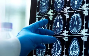 الرجال يفقدون بنية الدماغ أسرع من النساء.. دراسة تكشف مفاجآت جديدة عن شيخوخة الدماغ والزهايمر