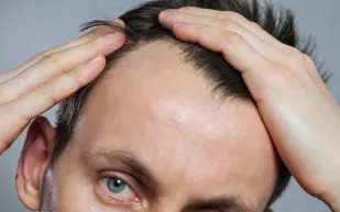 علاج ثوري للصلع: كريم يعيد إنبات الشعر بنسبة 539% دون آثار جانبية