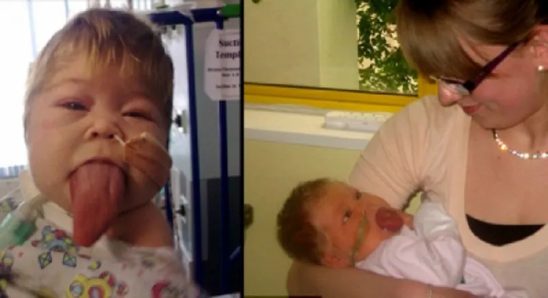 لسان طفلة بريطانية لم يتوقف عن النمو منذ ولادتها