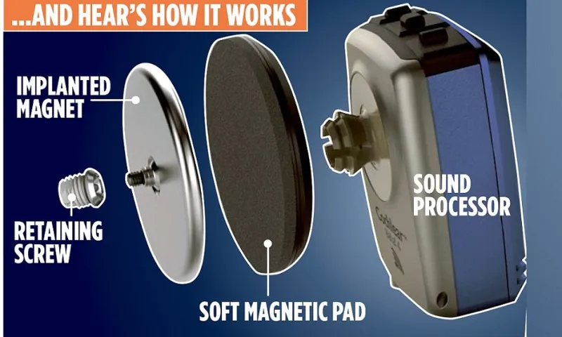 شريحة مغناطيسية تزرع بالجمجمة لاسترداد السمع