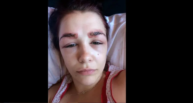 بالصور: تشوهت بعد عملية تجميل لحاجبيها