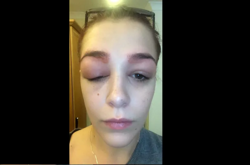 بالصور: تشوهت بعد عملية تجميل لحاجبيها