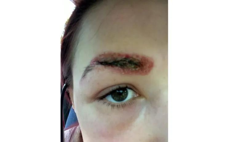 بالصور: تشوهت بعد عملية تجميل لحاجبيها