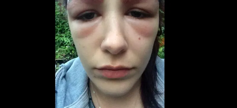 بالصور: تشوهت بعد عملية تجميل لحاجبيها