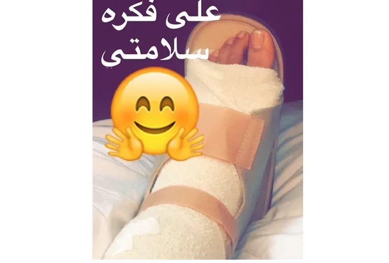 بالصورة.. أحلام تكسر ساقها بالصورة.. أحلام تكسر ساقها
