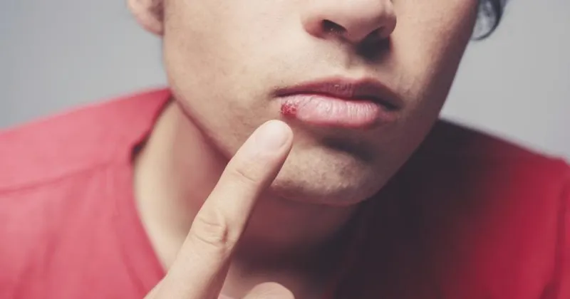 تقرحات الفم  كيف تتخلص منها 