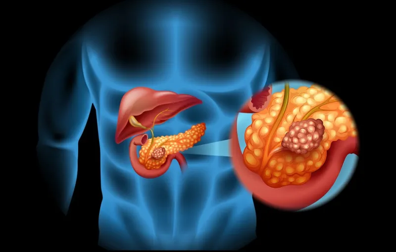 اكتشاف طريقة لتشخيص سرطان البانكرياس