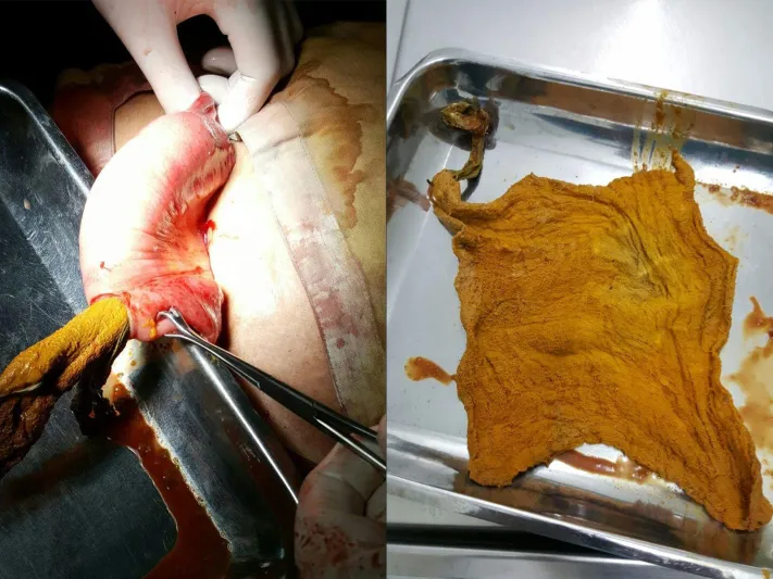 فيديو| بعد أربعة شهور من الولادة.. هذا ما وجدوها في بطنها!