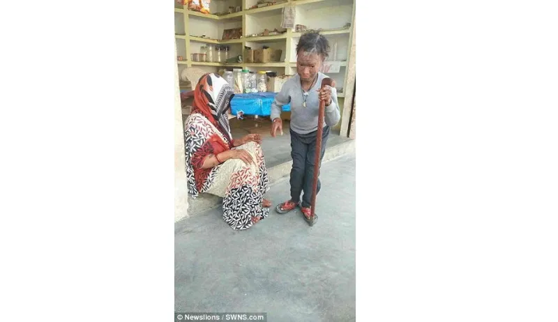 قصة الفتاة الثعبان يتغير جلدها كل 6 أسابيع وسبب طردها من المدرسة