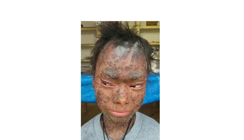 قصة الفتاة الثعبان يتغير جلدها كل 6 أسابيع وسبب طردها من المدرسة