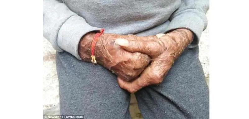 قصة الفتاة الثعبان يتغير جلدها كل 6 أسابيع وسبب طردها من المدرسة